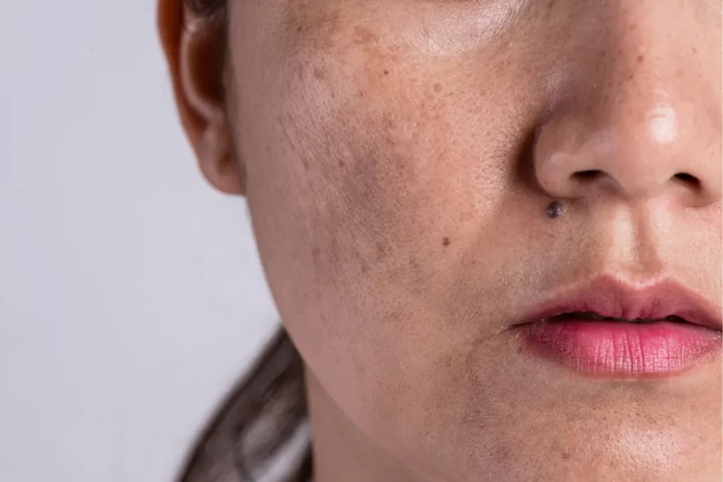 woman with melasma marks
