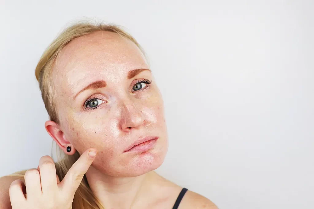 sad woman due to hyperpigmentaion