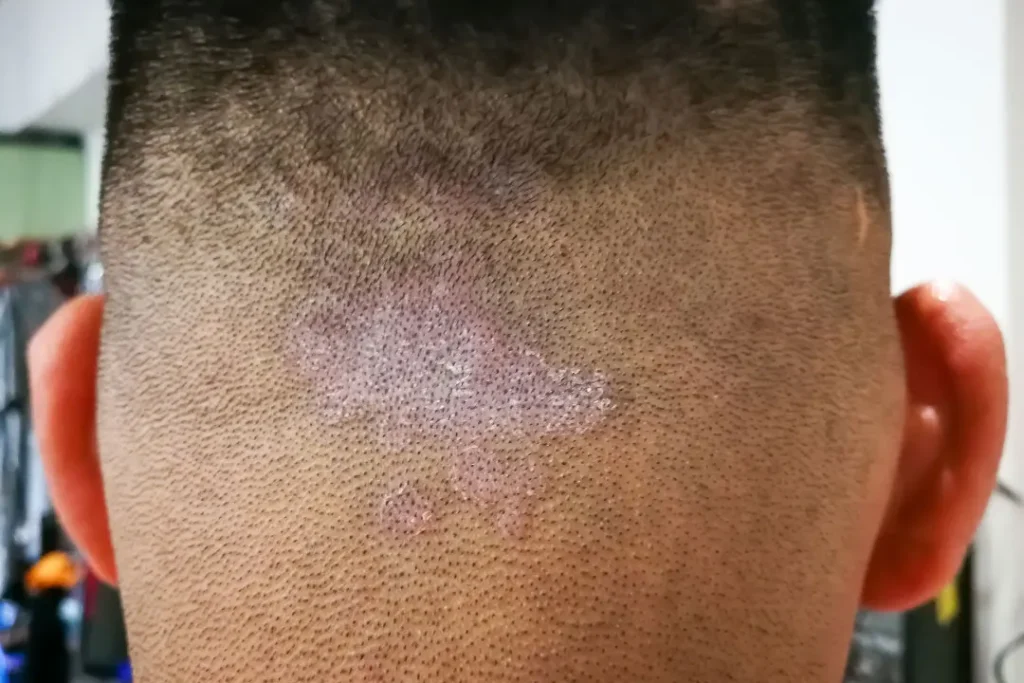 Allergy on scalp.