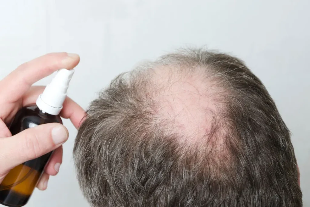 Hair spray for treating the hair loss.
