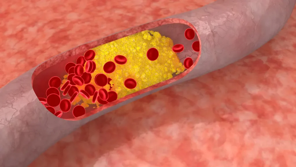 High level of cholesterol in blood vessel.
