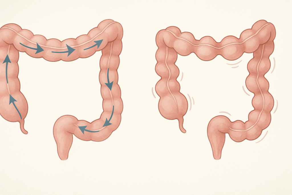 Medical infographic comparing normal colon contractions to uncoordinated spasms, illustrating what causes spastic colon attack